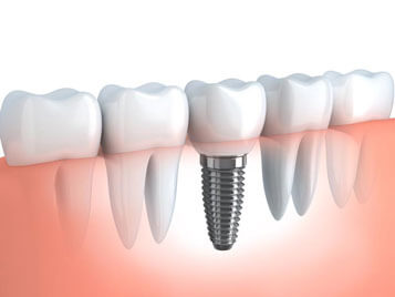 Dentist in Sandy Lake & Meadville, PA - Implants 